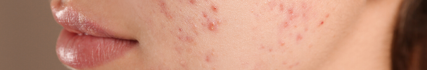 Natuurlijke middelen tegen acne